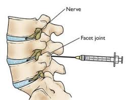 DRG block spine pain management