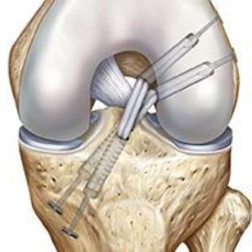 pcl reconstruction - knee pain