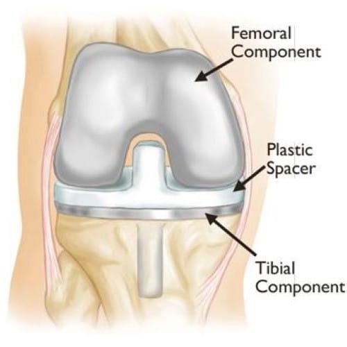 Total Knee replacement - after