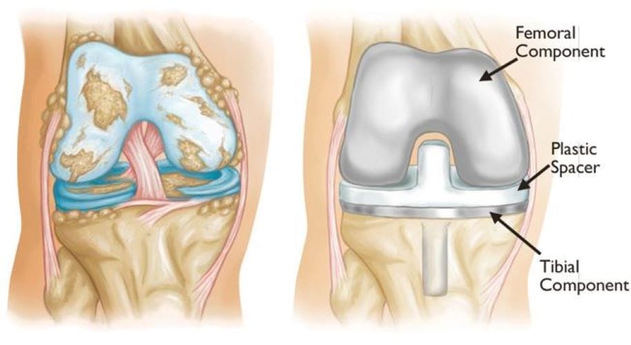 total knee replacement -before and after