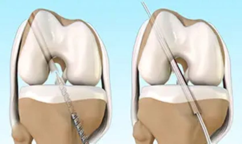 Knee replacement acl replacement