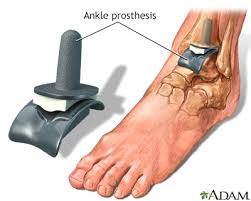 Ankle Arthroplasty - ankle repair surgery- dr sashi