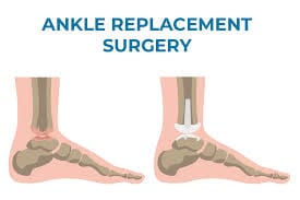 ankle replacement surgery - ankle pain treatment - ankle instability