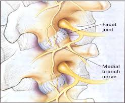 facet joint block - spine pain management