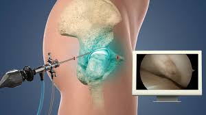 Hip pain - hip arthroscopy