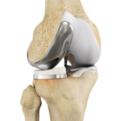 unicompartmental-knee-replacement