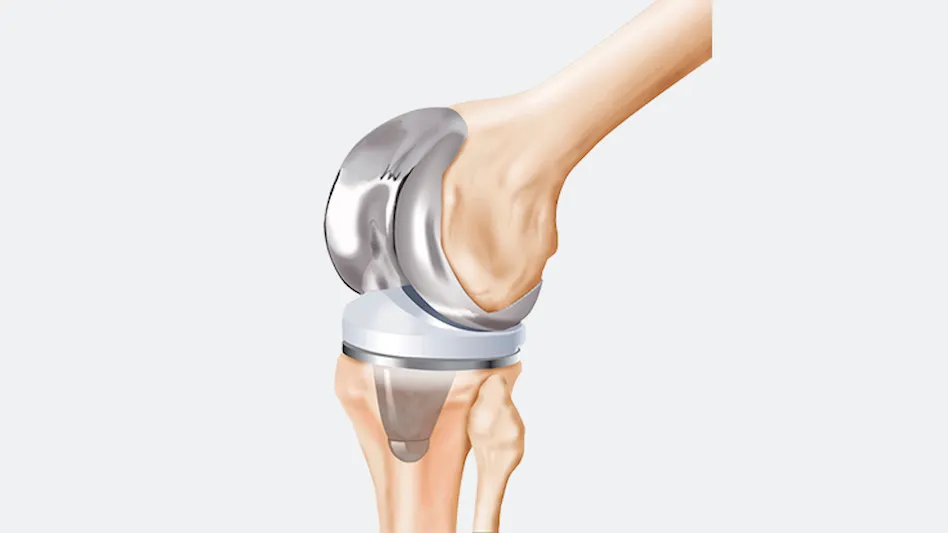 knee replacement surgery
